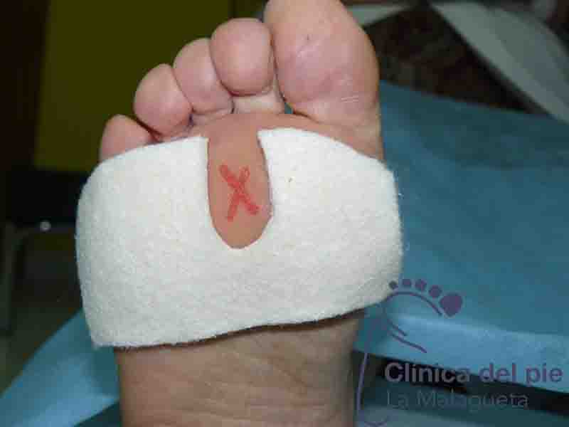 podologo-en-malaga-vendaje-provisional