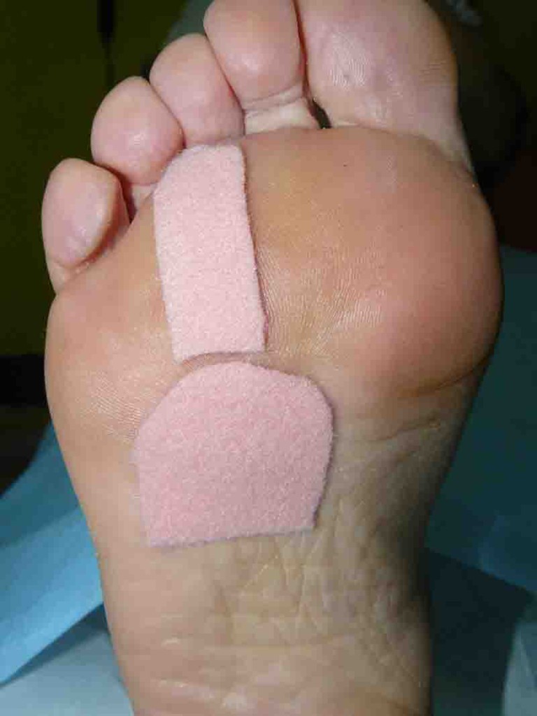 podologo-malaga-vendaje-provisional