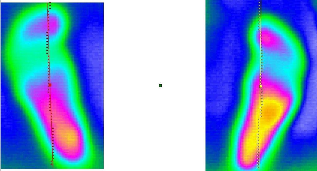 pie plano en niños podologo infantil malaga