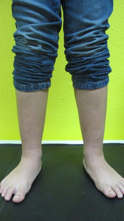 tratamiento pies planos en niños podologo infantil malaga