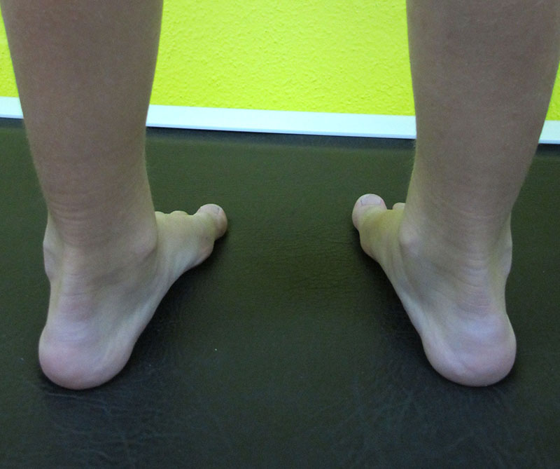 podologo infantil malaga puntas hacia dentro